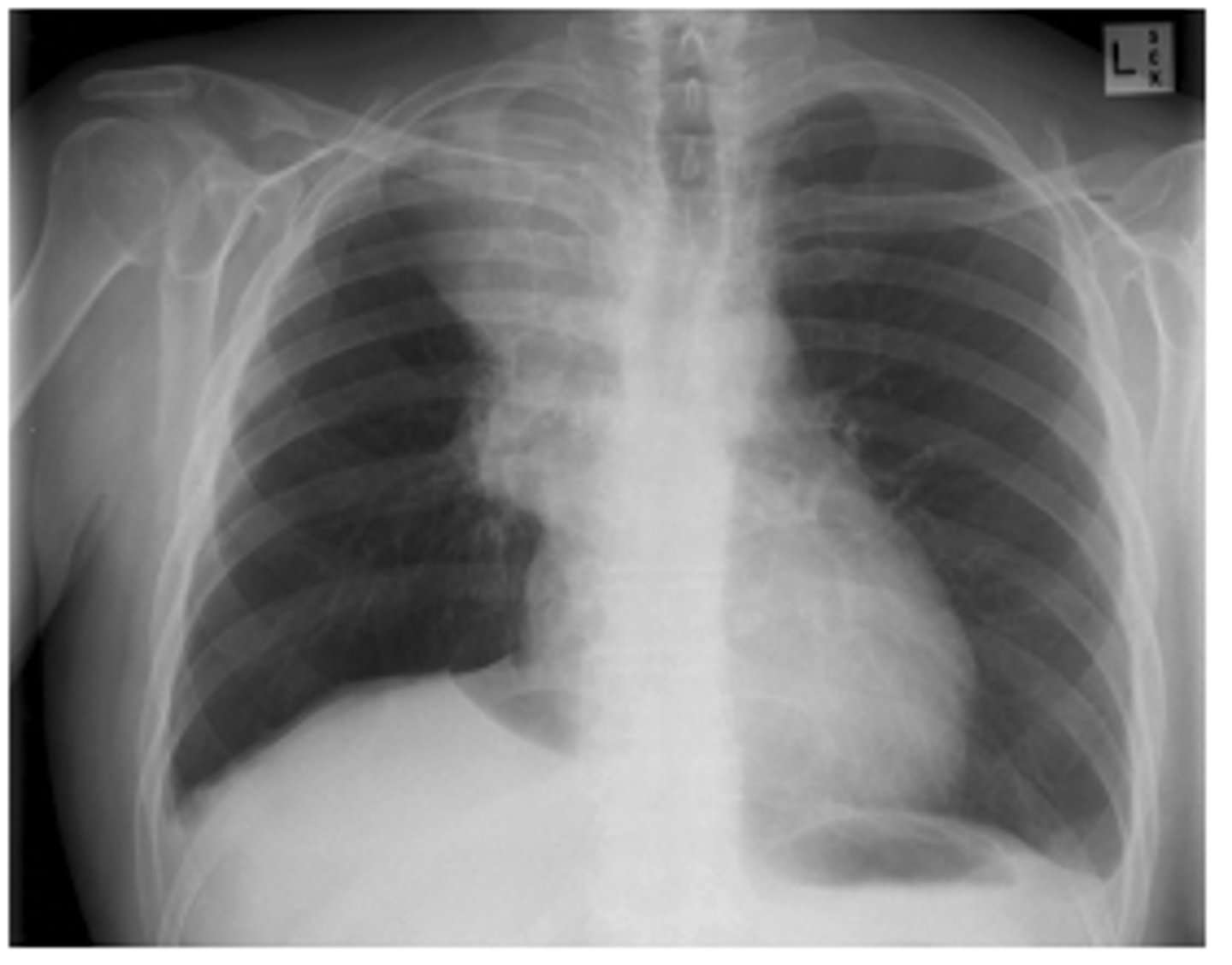 <p>often present as an indistinct hilar or mediastinal mass. (pic: R hilar and paratracheal region)</p>