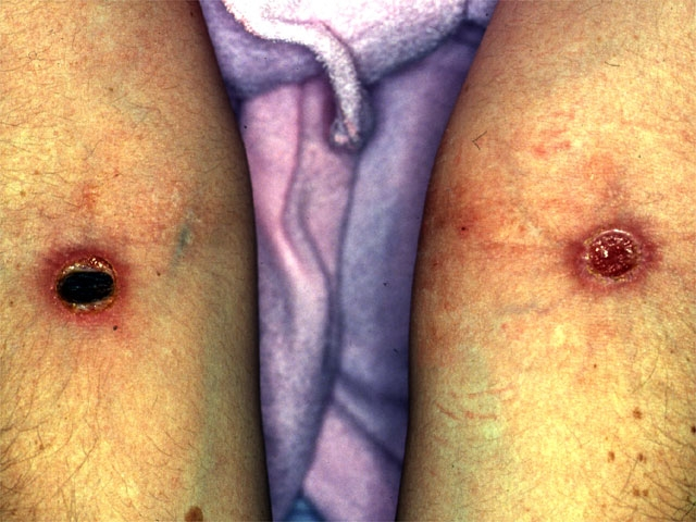 <p>35 yo woman w/ multiple painful oral ulcers, hx anterior uveitis, genital lesions, scattered hyperpigmented lesions, and tender, indurated areas on legs. </p><p>dx? what is the image of?</p>