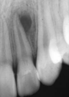 <p><strong>Lateral Periodontal Cyst</strong></p>