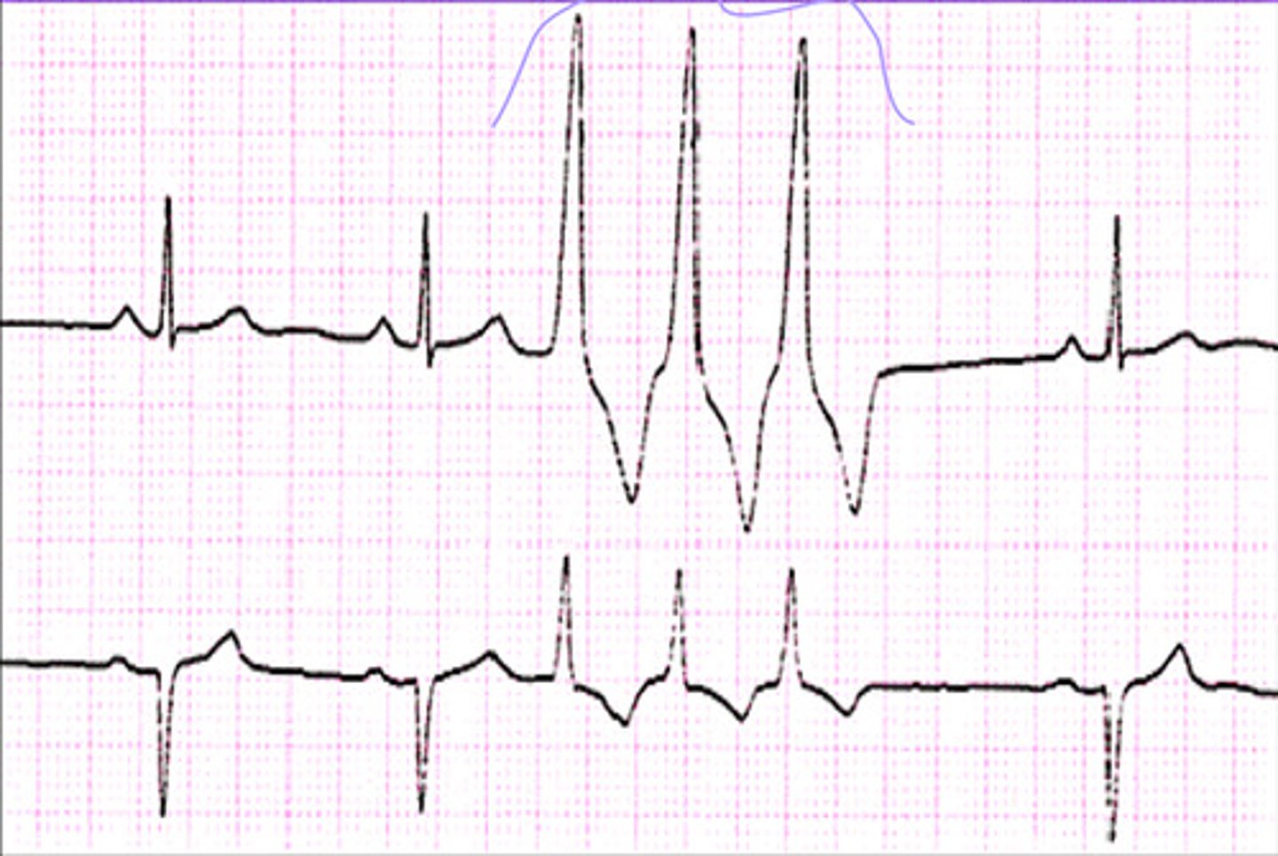 <p>What does the ECG show?</p>