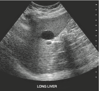 <p><span>A patient who is complaining of postprandial pain presents for an abdominal ultrasound. Laboratory values are within normal limits. Based on this clinical history and sonogram, the mass is most suspicious for a (an):</span></p>