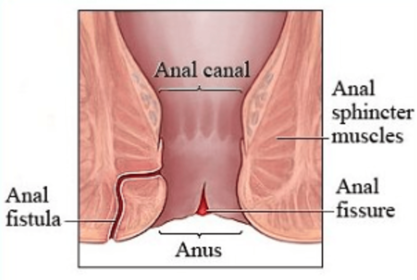 <p>affects entire GI tract from mouth-anus, small and large intestines</p><p>can have skipped lesions</p><p>ulcers, fissure (narrow tear from spincter to canal), fistulas (tract from anal canal --&gt; hole in skin near anus), alterations in digestion and absorption --&gt; malnutrition</p><p>rx: antinflammatory drug for bowel, prednisone (immunosupressant), antibiotics, biologic therapy</p>