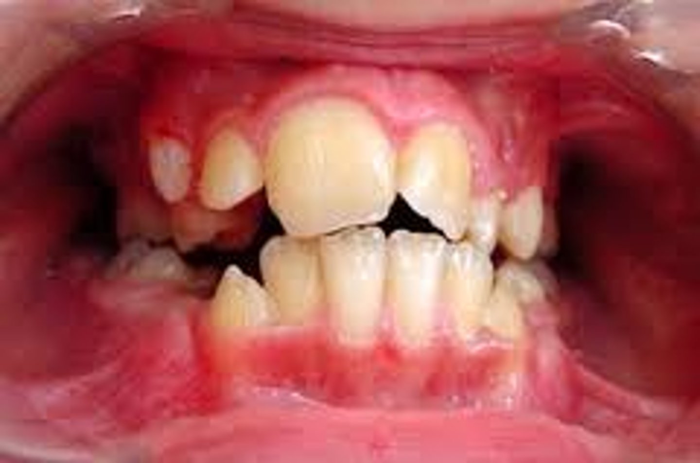 <p>Abnormally large teeth</p><p>- fusion</p><p>- gemenition</p>