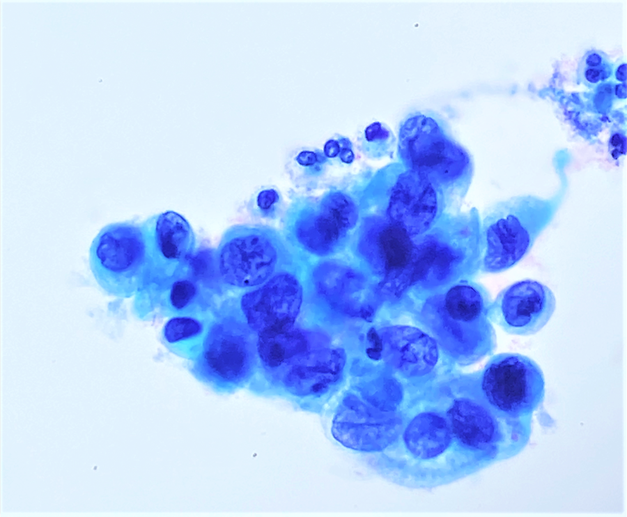 <p>Frottis : Petites cellules hyperchromatiques à N/C élevé en amas syncytiaux.</p><p>1) diagnostic principal</p><p>2) dd pertinents</p><p>3) clés d’exclusion</p><p>4) conduite</p>