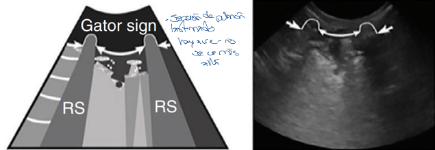 <p>Área focal de cambio pulmonar alveolar con broncogramas aéreos<span style="font-family: Aptos, sans-serif; line-height: 115%;"><span>, visible como áreas ramificadas hiperecoicas</span></span></p>