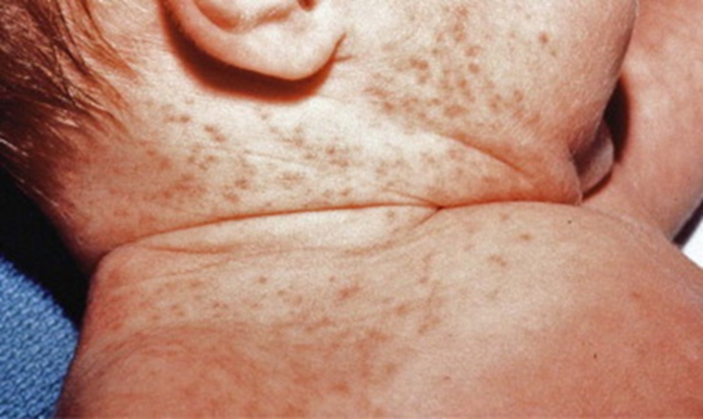 <p>Rubra = erythematous papules on skin folds </p><p>Crystallina = clear vesicles on head/neck &amp; upper trunk</p>