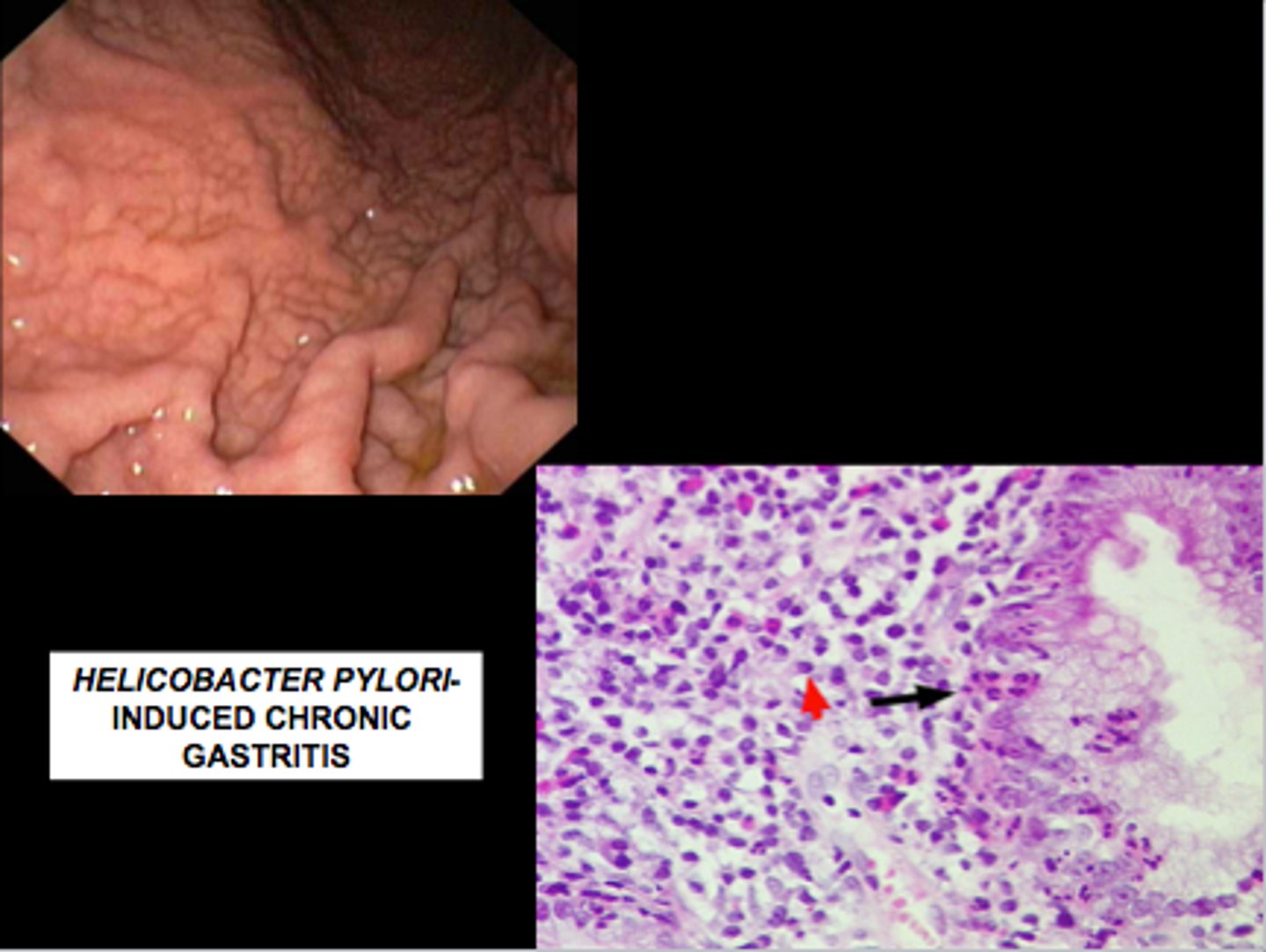 <p>Pathogen: Helicobacter pylori</p><p>S+S: Chronic inflammation of the gastric mucosa --&gt; early satiety, indigestion, nausea, vomiting, ulcer formation, pyrosis when the stomach is empty, epigastric pain</p><p>Transmission: Saliva, fecal-oral route</p>