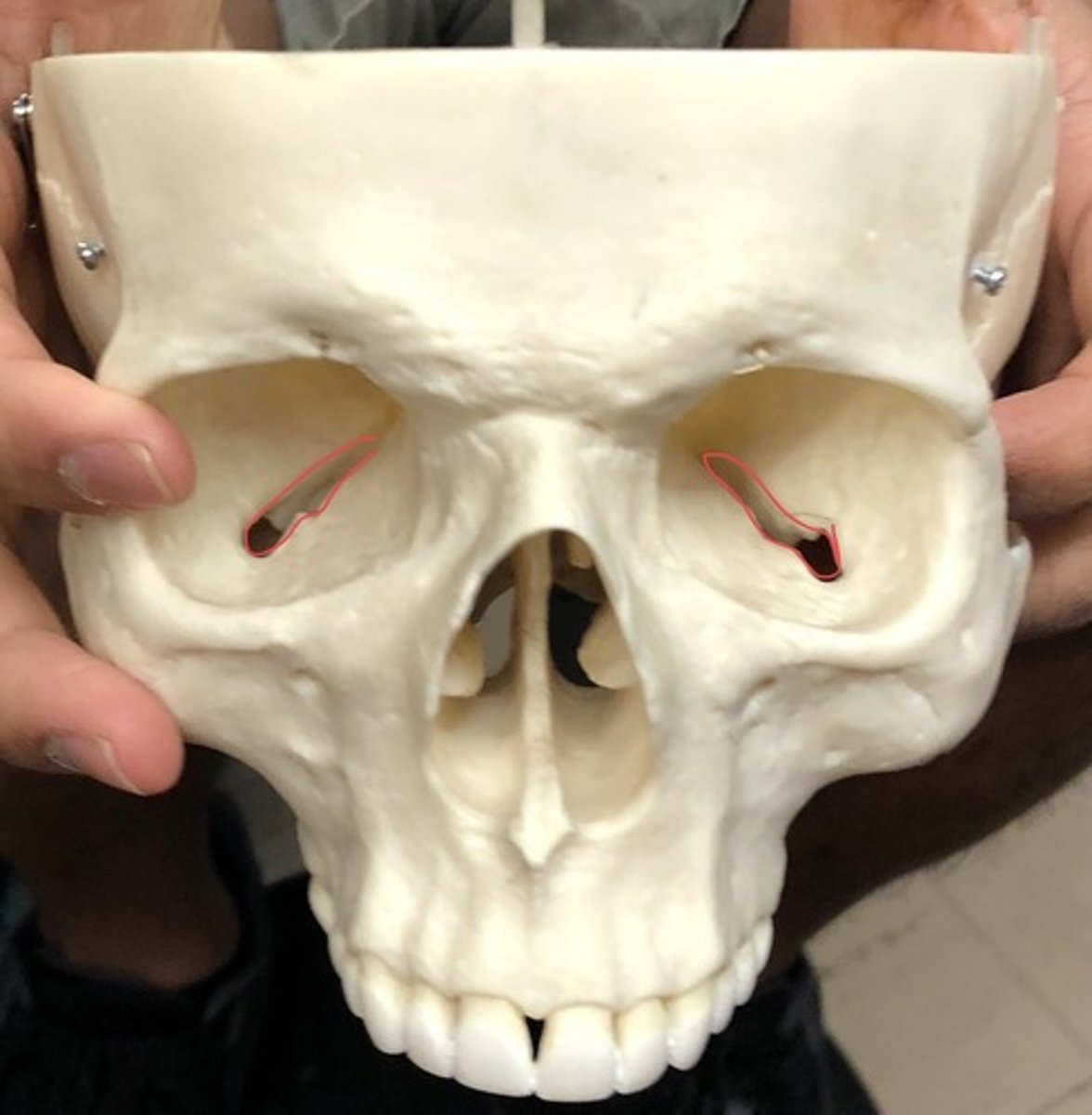 <p>Large gap in the bottom of eye socket; below superior</p>