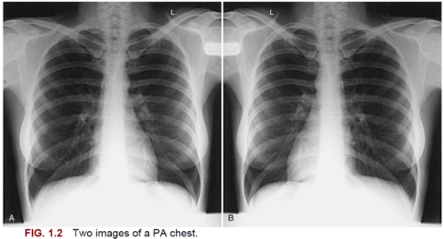 <p>69. Fig. 1.2 shows two images of a PA projection of a chest. Which image (A or B) is correctly displayed?</p>