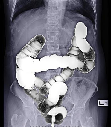 <p>Barium Enema: Identify the Position</p>