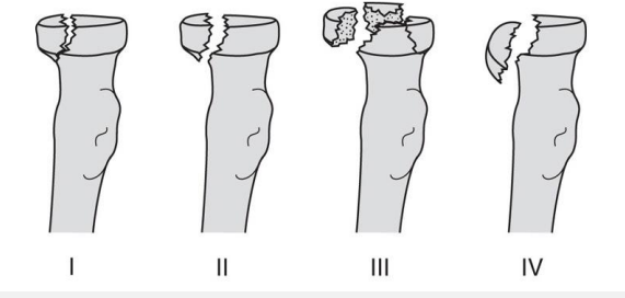 <p>Type 1 = undisplaced </p><p>Type 2 = displaced with separation of fragment </p><p>Type 3 = comminuted fractures </p><p>Type 4 = radial head fracture associated with elbow dislocation</p>