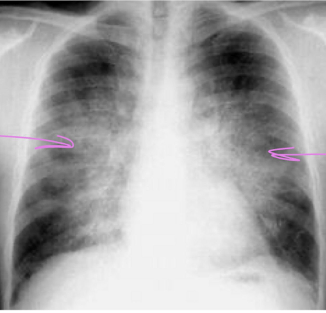 <p>What "sign" is this? What is the most common cause?</p>