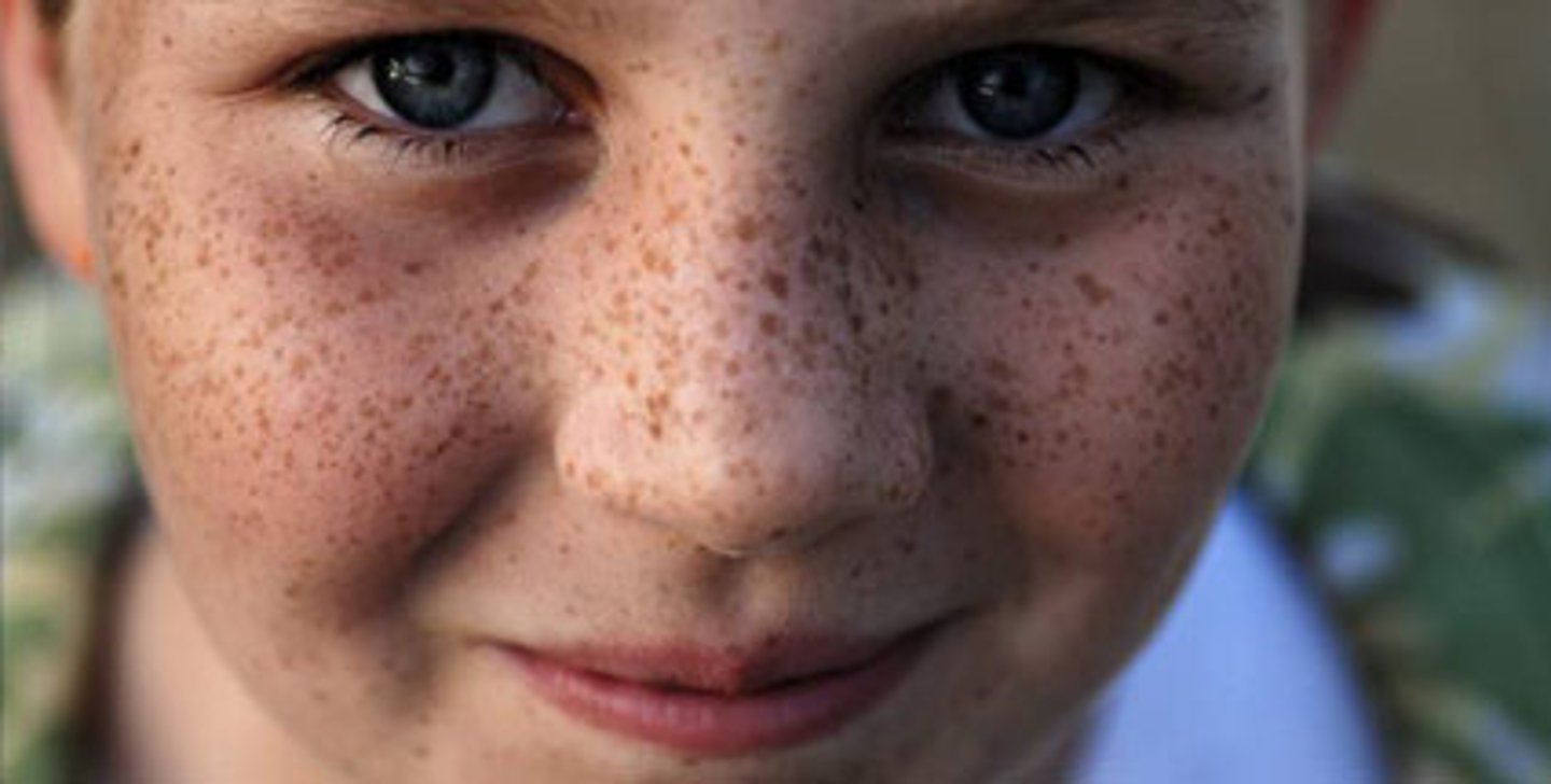 <p>i have freckles</p>