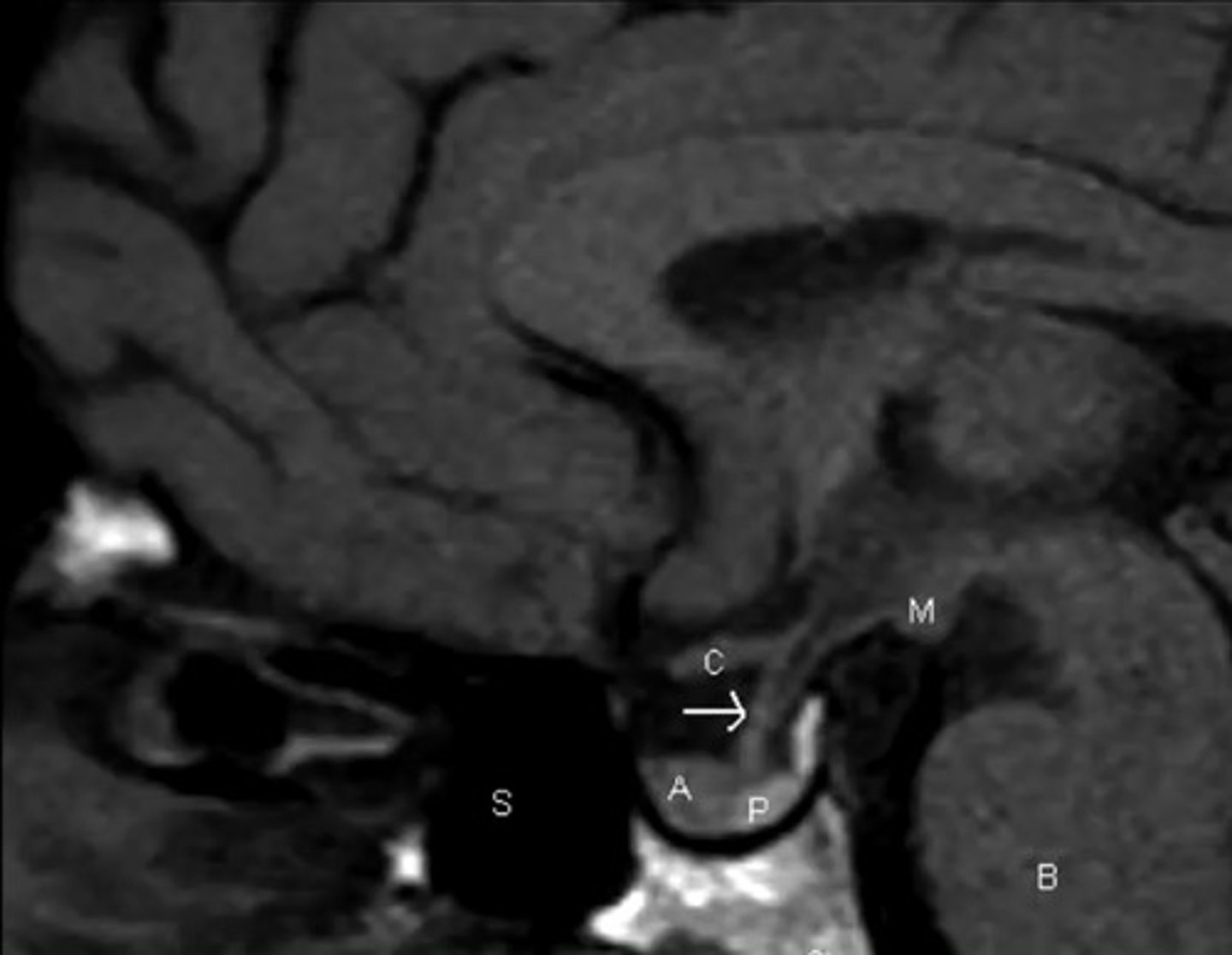 <p>You might have to order special testing, to get thin enough slices to catch smaller tumors</p>