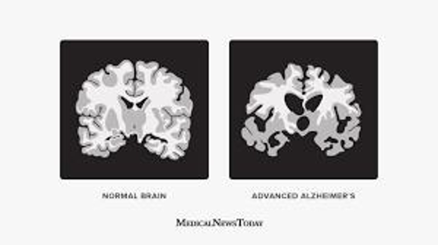 <p>Loss of brain cells leading to severe memory loss.</p>