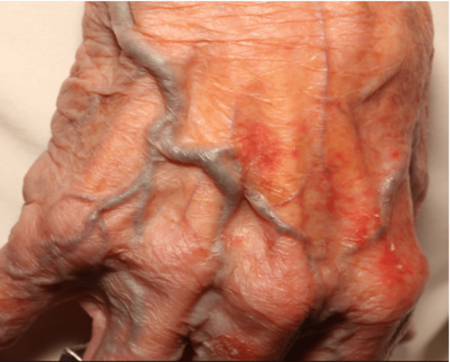 <p>Thinning of the skin with the loss of the normal skin furrows</p><p>- Skin looks shinier and more translucent</p><p>- Seen in aging</p>