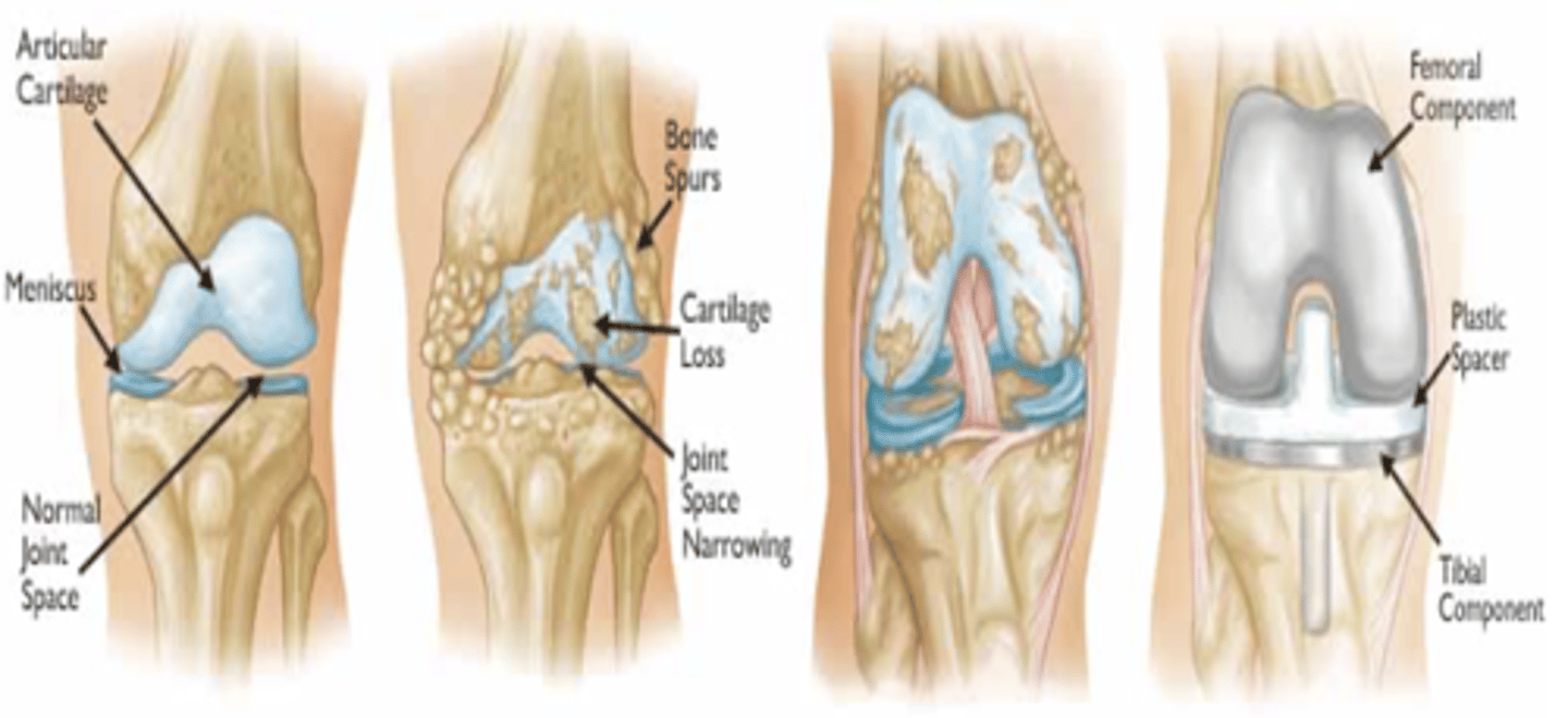 <p>-Compensatory Strategies for ADL's such as dressing and bathing, for IADLS's<br>-Using walker<br>-How to safely monitor knee and surgical site<br>-Encourage as much extension of knee as possible<br>-Weight bear according to doctors' recommendations<br>-No crutches until cleared<br>-Education on how to functional and safe mobility aka turn without rotating<br>-Safe positioning of knee (no pillows)</p>