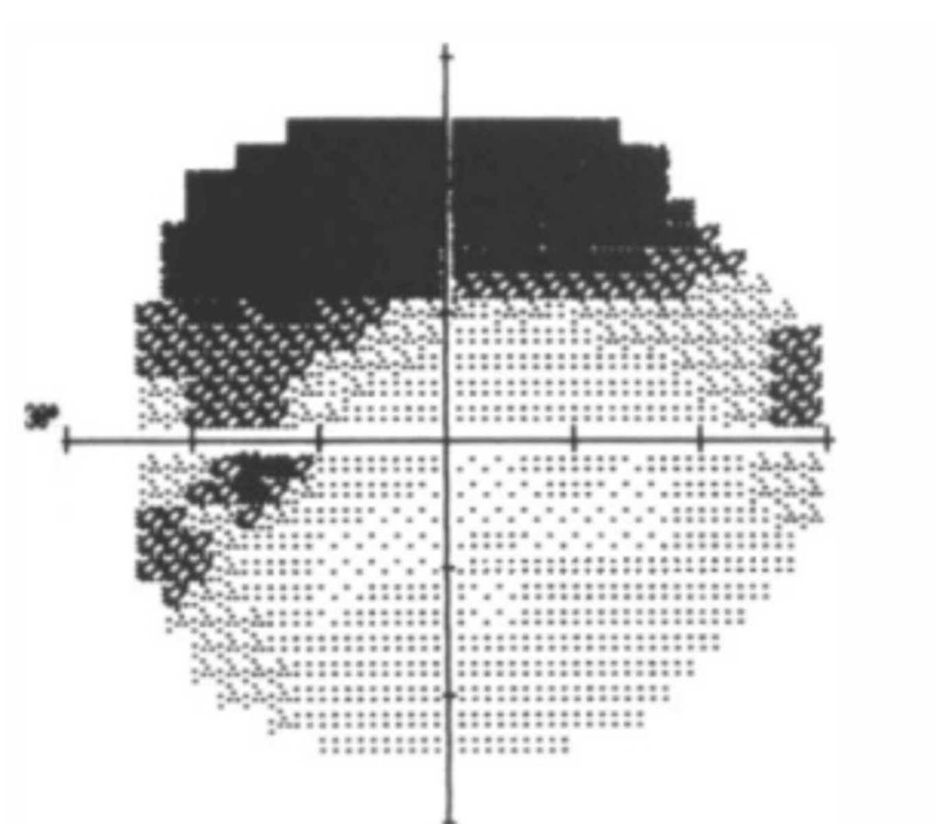 <p>Dermatochalasis will show a visual field defect...</p>