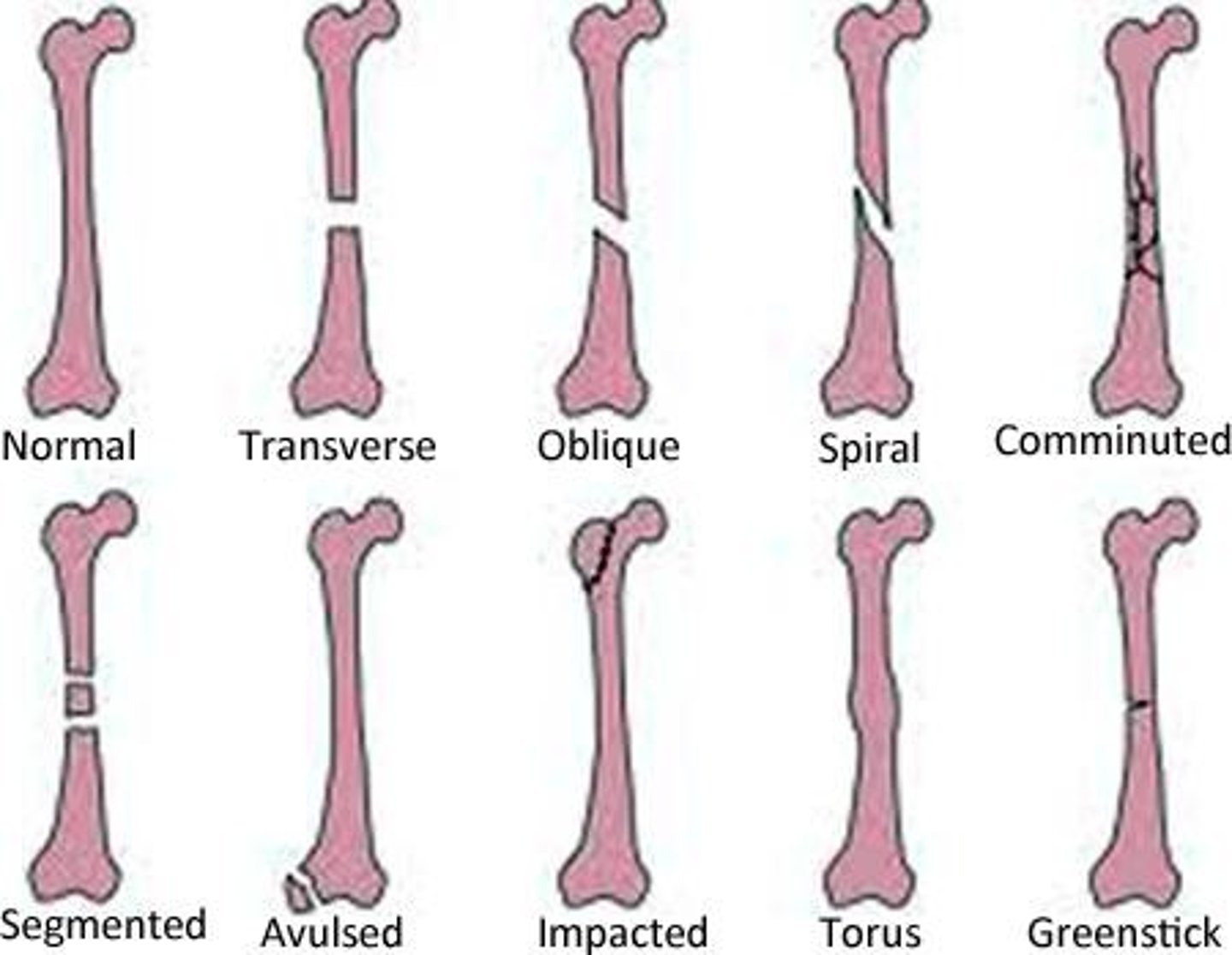 <p>An incomplete fracture of a long bone, typically occurring midway; if displaced, it must be reduced and placed in a long arm cast.</p>