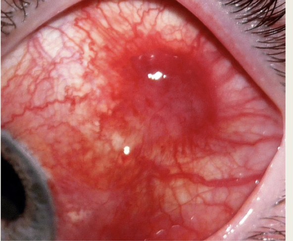 <p>flat bright red lesion</p><p>no discharge</p><p><em>affects lashes and lids in&nbsp;notes</em></p>