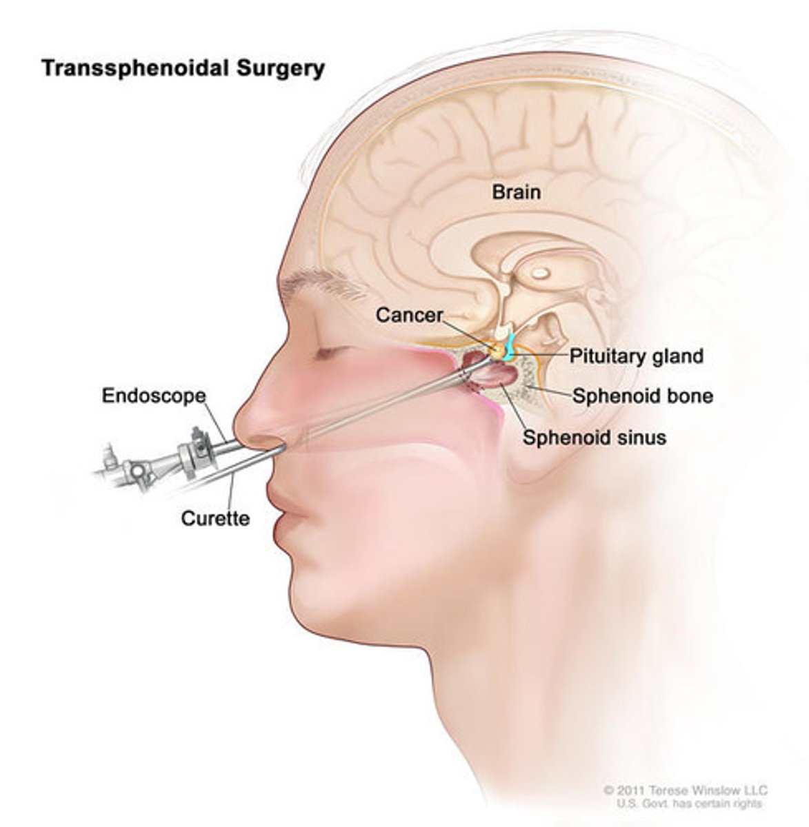 <p>endoscopic procedure to surgically remove a pituitary tumor through an incision in the sphenoid sinus without disturbing brain tissue</p>