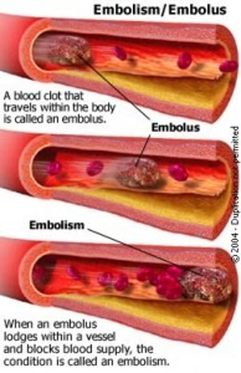 <p>A blood clot that breaks free and travels through the bloodstream</p>