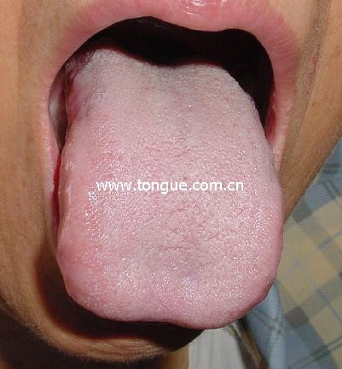 <p>Deficient in yang, blood, &amp;/or Qi.</p><p>Deficiency cold</p>