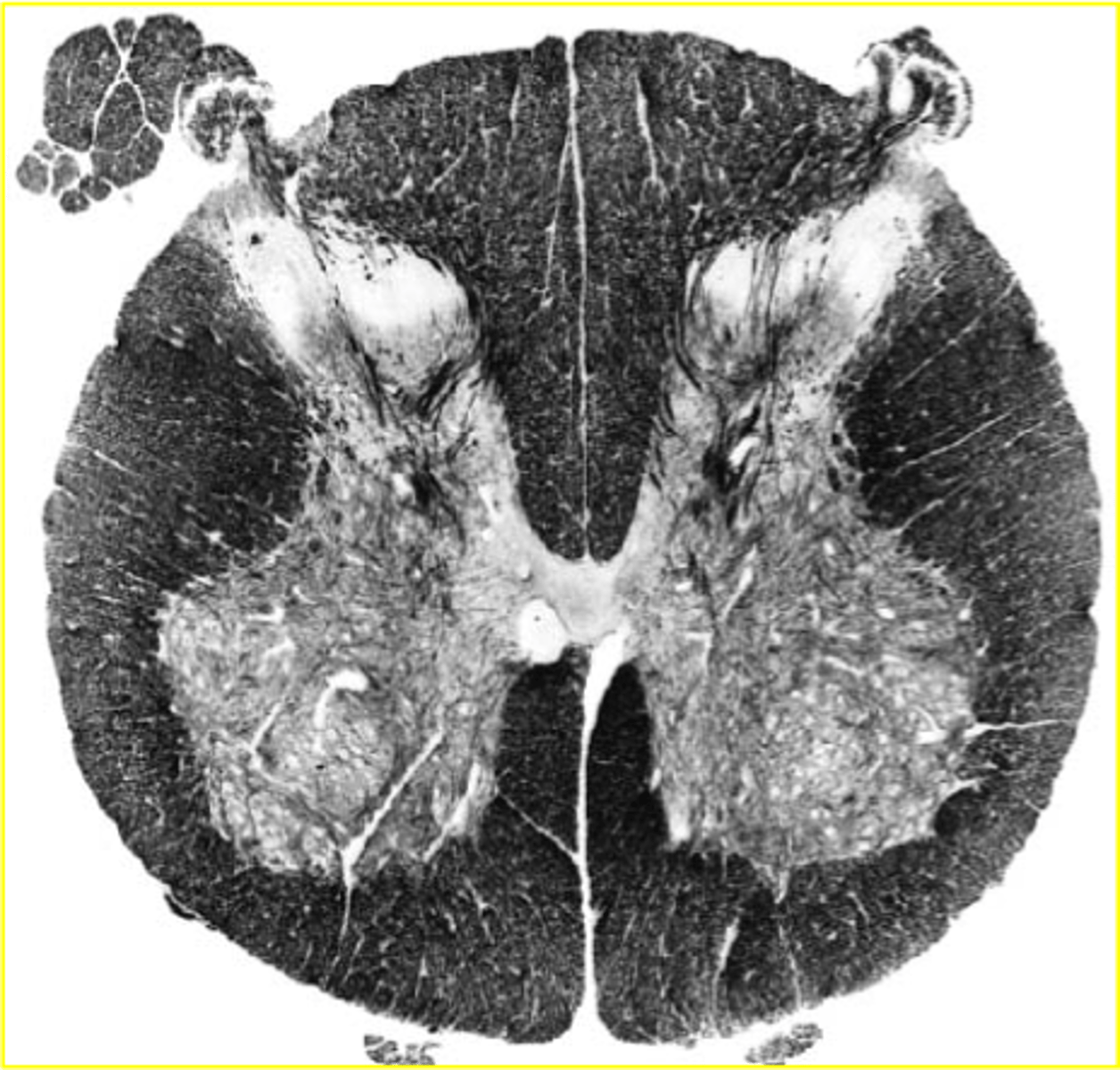 <p>large anterior/posterior grey horns; considerably less white matter compared to cervical</p>