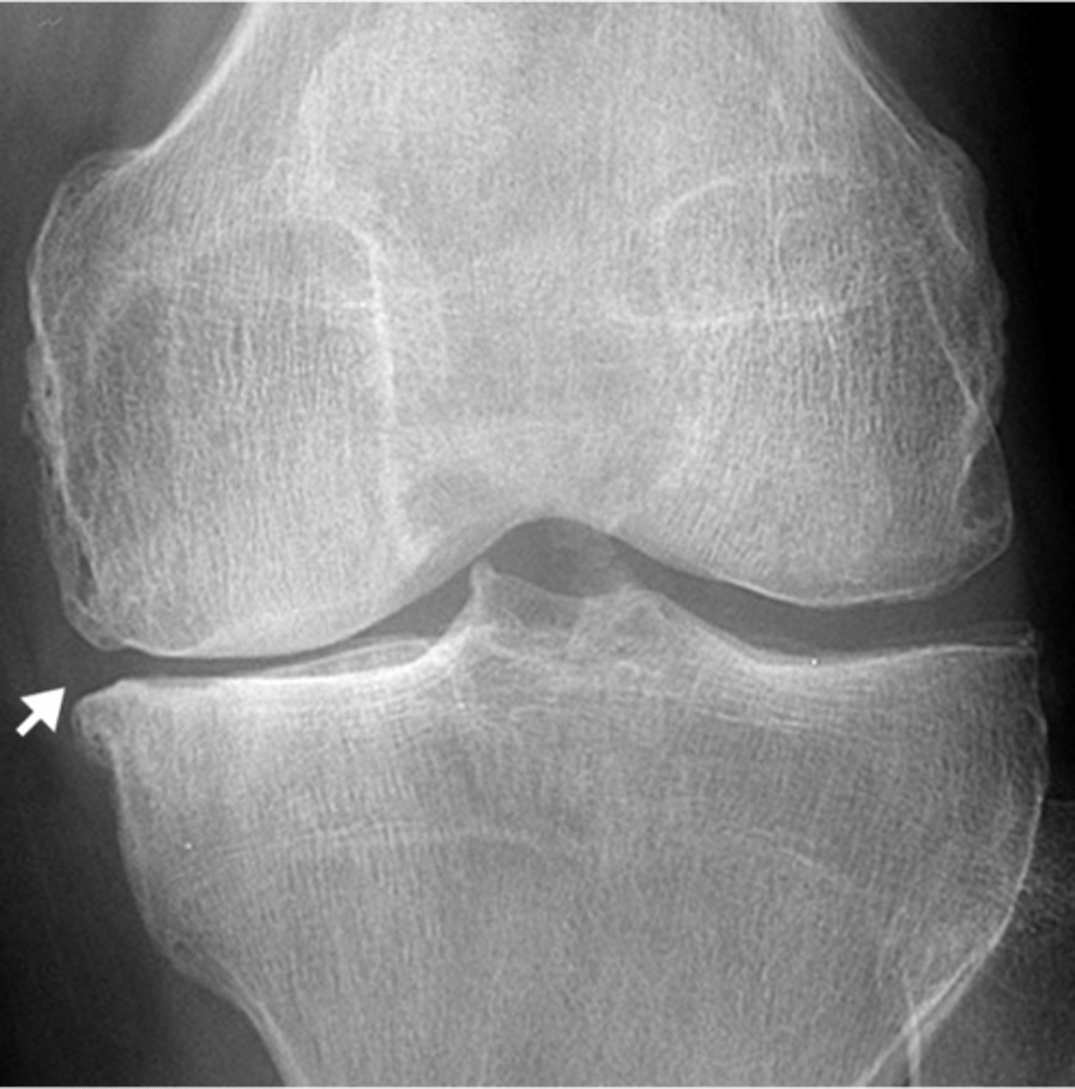 <p>ID type of arthritis</p>