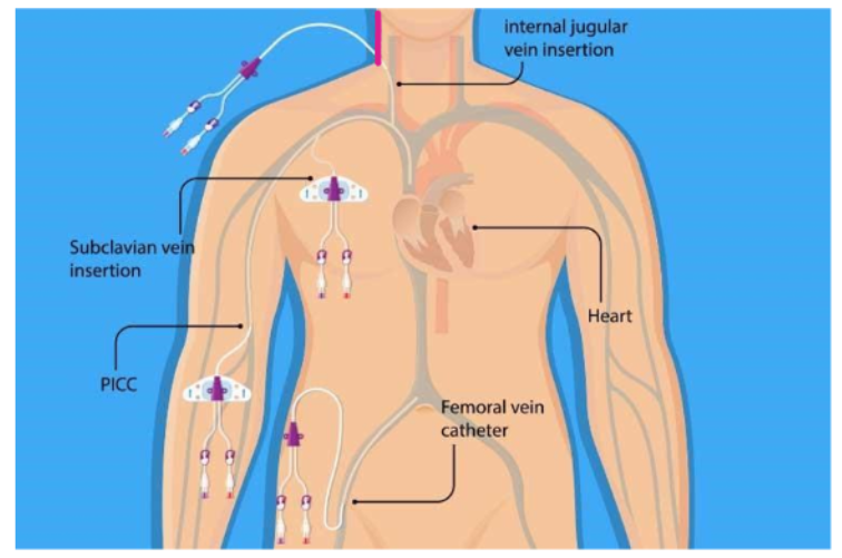 <p>IV access through a larger vessel, generally placed in the neck, groin, or upper chest </p>