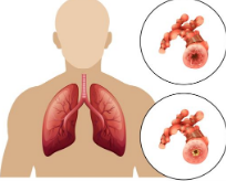 Chronic Obstructive Pulmonary Disease (COPD)