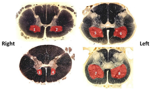 <p>PI: a unilateral lesion of which of the following results in right upper limb flaccid paralysis?</p>