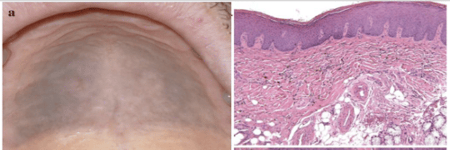 <p>What type of pigmented lesion?</p>