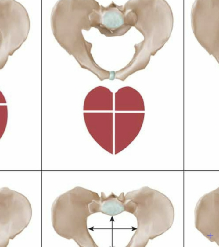 <p>pelvis adequate for 20% of assigned males at birth; <strong>heart</strong> or wedge-shaped; reduced in all diameters; arrest of labor common</p><ul><li><p><strong>not favorable for vaginal birth</strong></p></li></ul><p></p>
