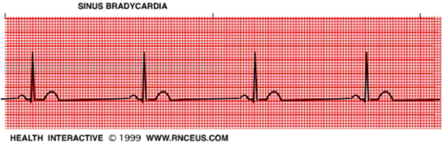 <p>less than 60 bpm</p><p>treat with atropine; if atropine is ineffective, transcutanoues pacemaker</p><p>possible dopamine or epi</p>