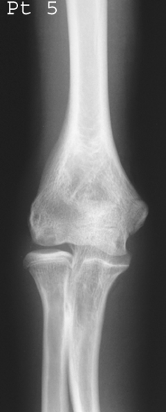 <p>Who is most affected by Osteochondritis Dissecans?</p>