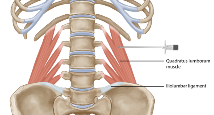 <p>origin: rib 12, lumbar transverse process L1-L4</p><p>insertion: iliolumbar ligament and iliac crest</p><p>innervation: T12, L1-L4</p><p>action: - extend vertebral column</p><p>-laterally flex vertebral column</p>