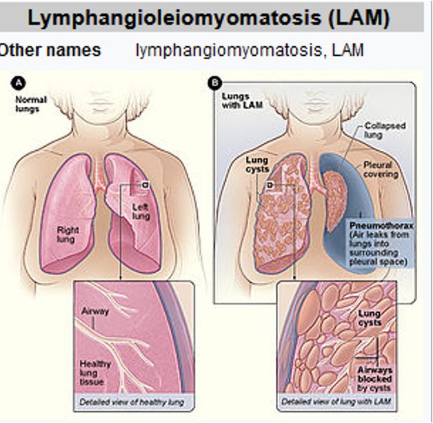 <p>-Rare disease that usually affects females in their late 20s, early 30’s</p><p>→cause by mutations in tuberous sclerosis complex (TSC) genes: abnormal cells spread to kidneys, lungs, and lymphatic system through blood stream</p><p>-Abnormal growth of smooth muscle cell, especially in the lymphatic system, lungs, and kidneys</p><p>-No cure, tx to focus on management of sxs</p><p>-S&amp;S: SOB, fatigue, and cough</p>