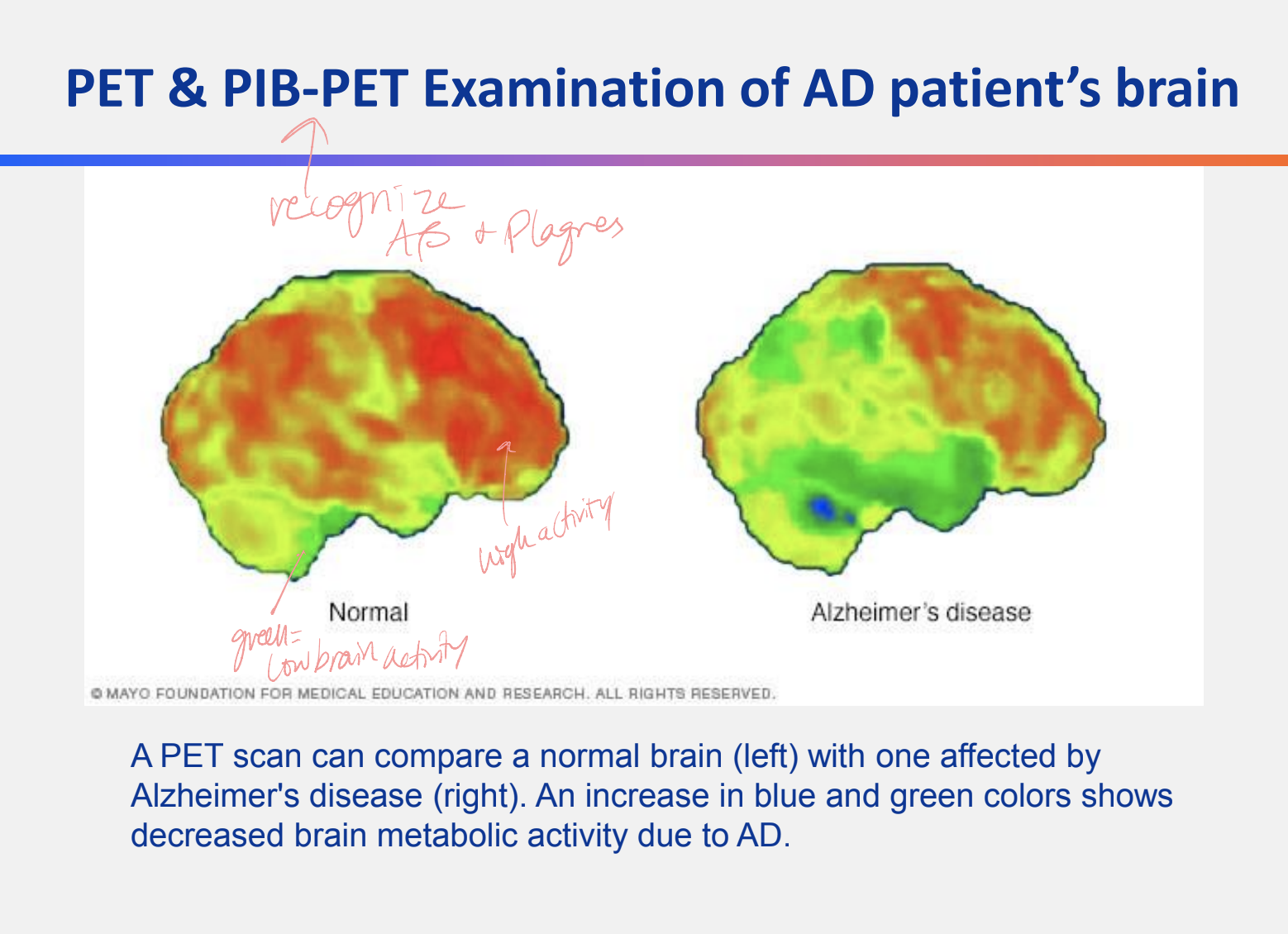 increase of blue and green (low brain activity) rather than red (high brain activity) → shows decreased brain metabolic activity due to AD

* PIB-PET recognizes A-beta and plaques
