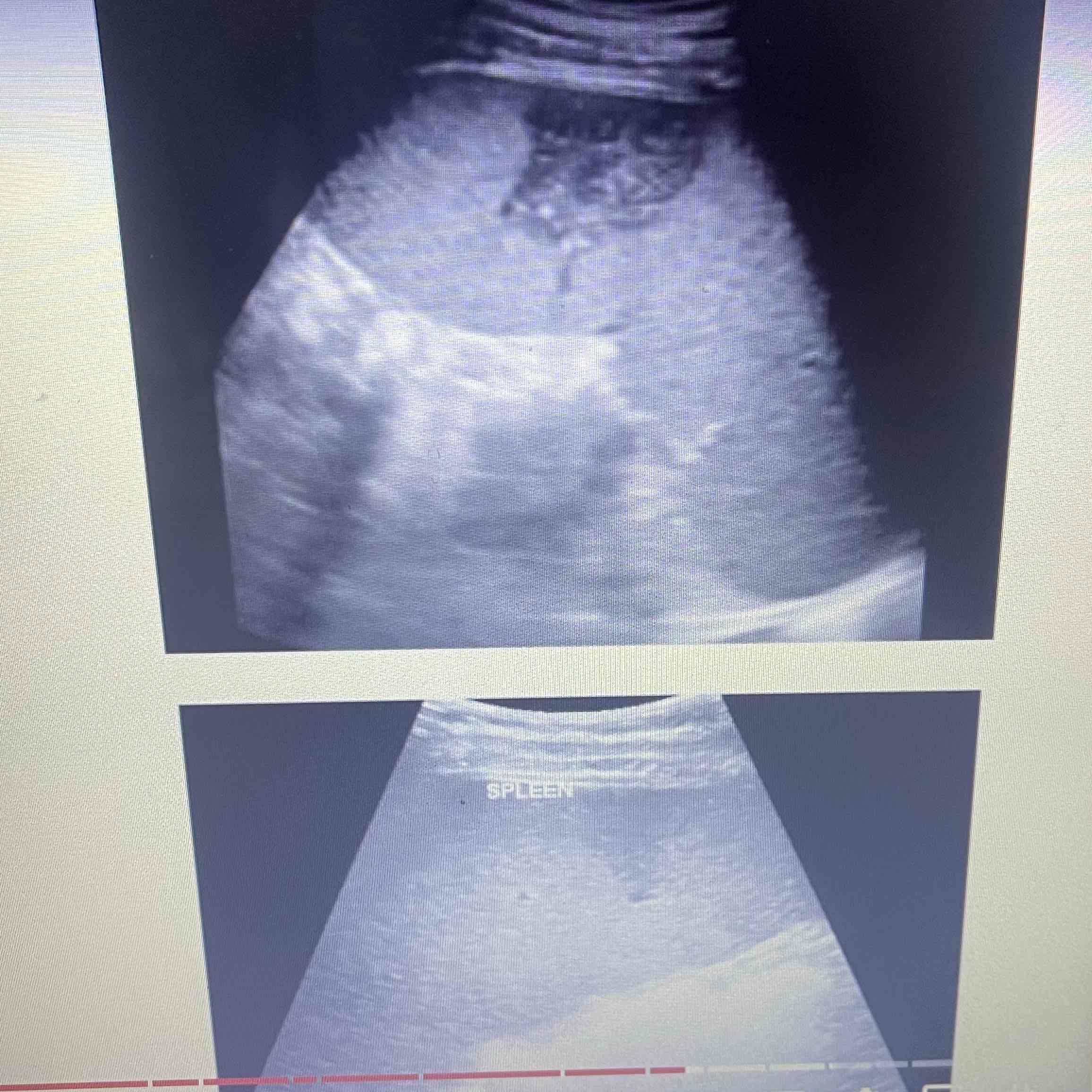 <ul><li><p>Death of focal splenic tissue: May affect a segment or entire organ</p></li><li><p>MC cause of focal splenic lesions</p></li><li><p>Caused by occlusion of splenic arteries/Branches: Result of embolus from heart</p></li><li><p>Clinically: Pancreatitis, leukemia, lymph disorders, SCA</p></li><li><p>Sonographic: NO Splenomegaly, acute: Hypoechoic wedge, Chronic: echogenic Wedge</p></li></ul>