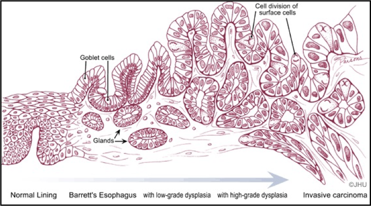 <p>what does intestinal metaplasia lead to </p>