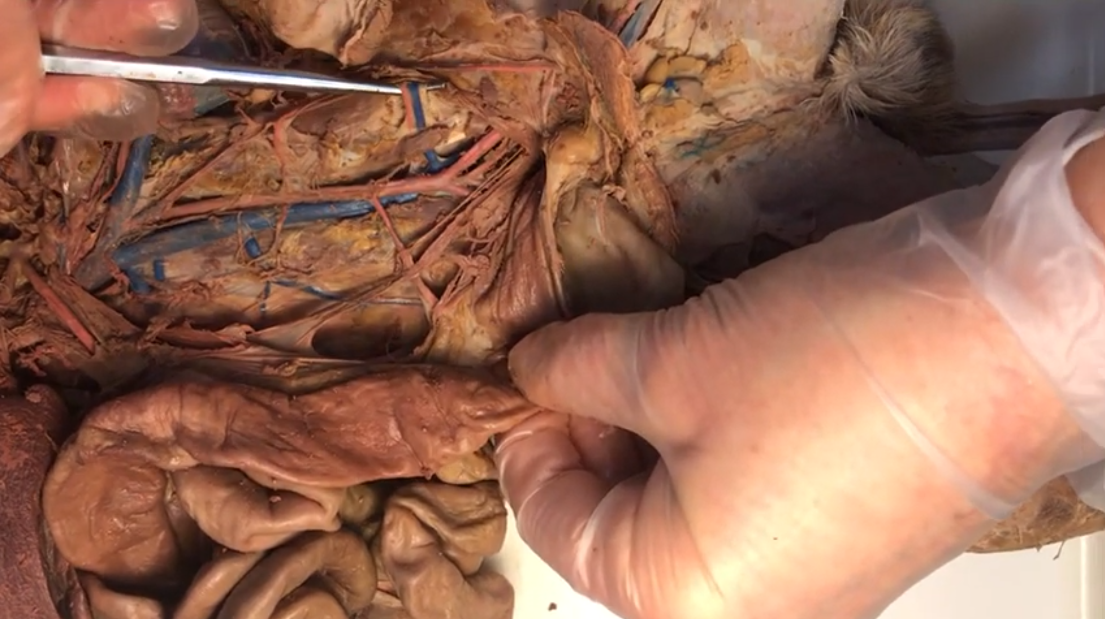 <p>What artery is this</p>
