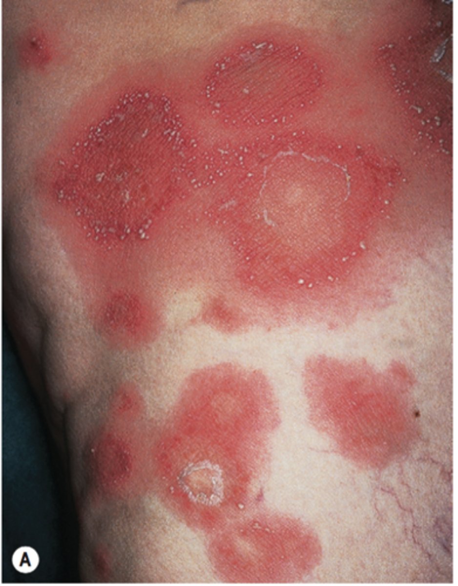 <p>-skin breakdown</p><p>-occurs at 4000-6000 cGy</p><p>- Acute skin reaction</p>