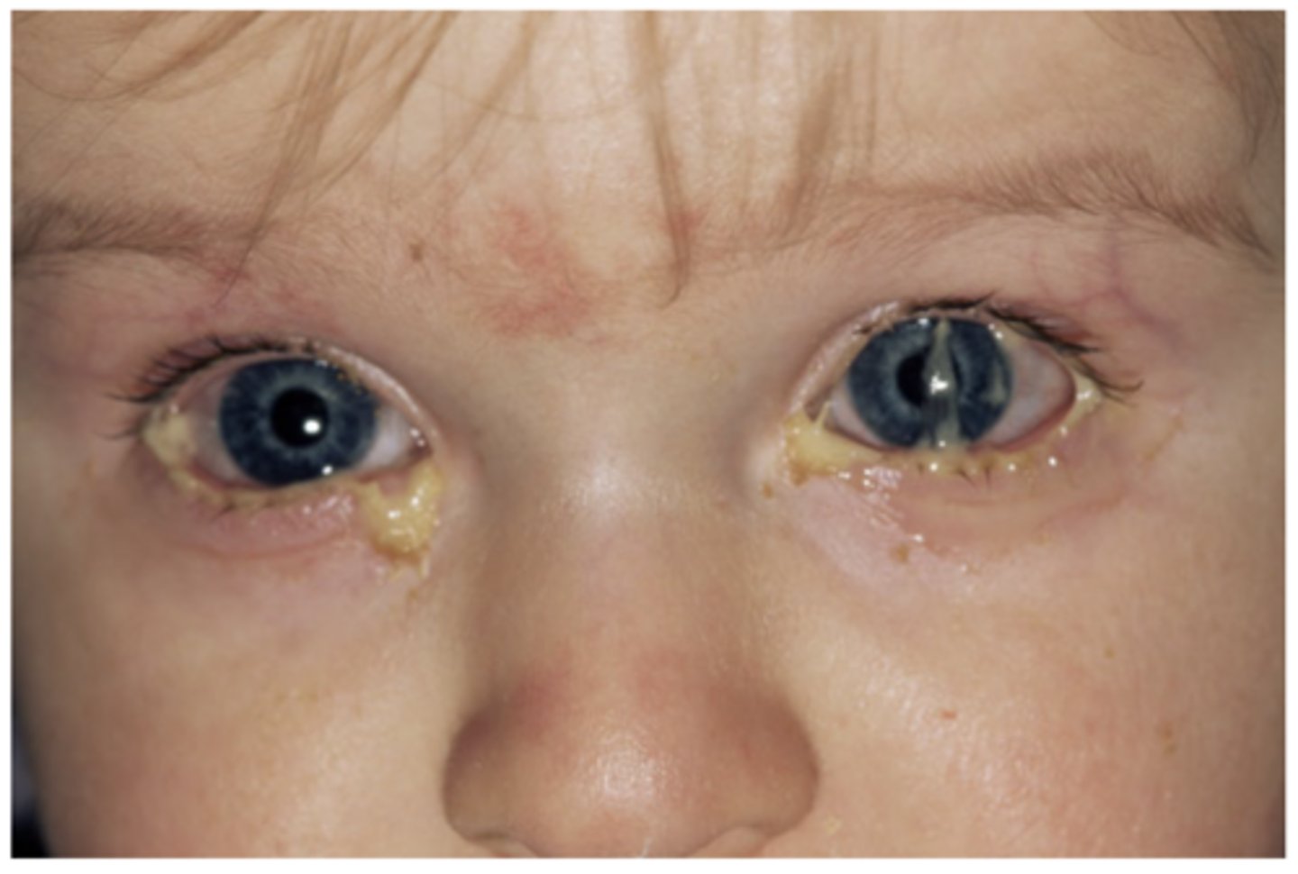<p>The pictured 4-year-old, non-contact lens-wearing male presents with complaints of eye irritation and the following ocular presentation. What type of ocular discharge is this? What's your differential diagnosis? What is the most likely offending microorganism? What is the best treatment plan for this patient? How long will it likely take for this patient's condition to resolve if treatment is initiated?</p>