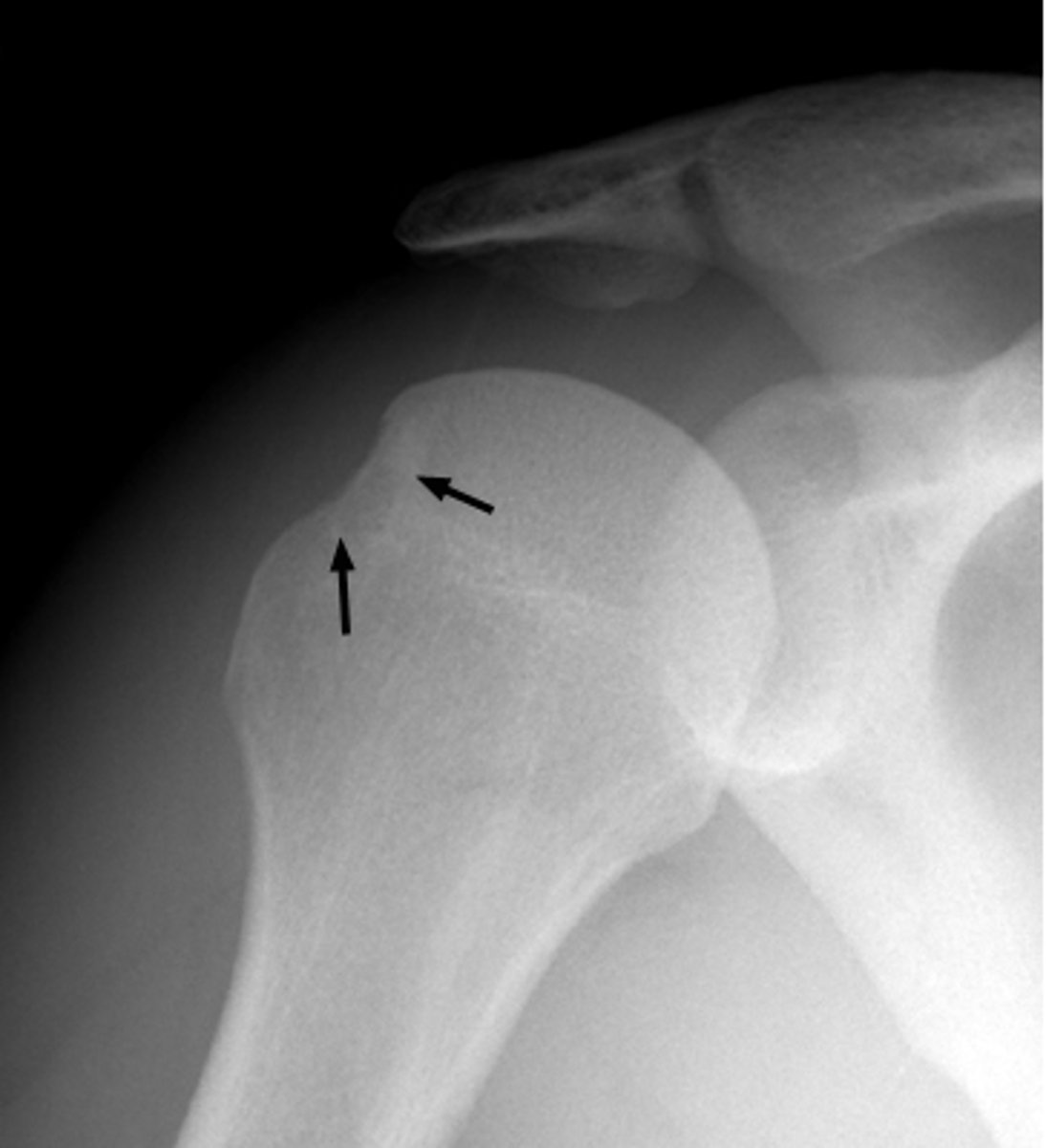 <p>superior and lateral damage from repeated anterior dislocations</p>