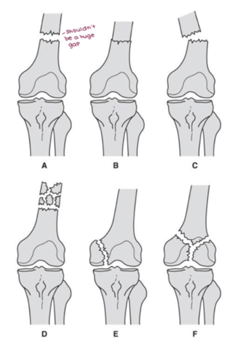 <p>- supracondylar (nondisplaced, impacted, displaced, comminuted)<br>- condylar (fx at condyle)<br>- intercondylar (between condyles)</p>