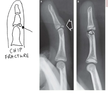<p>Isolated bone fragment NOT caused by tendon or ligament</p>