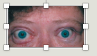 <p>exophthalmos</p>