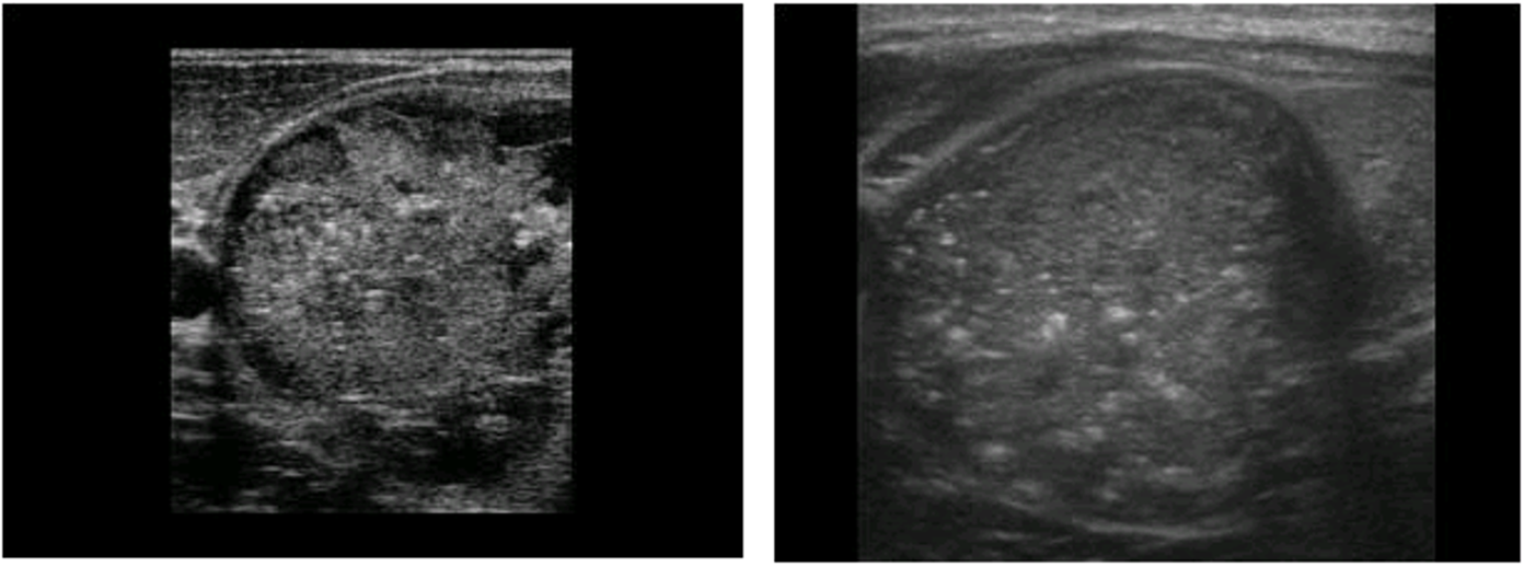 <p>most common form of thyroid cancer</p><p>ages 20-30</p><p>hypoechoic, microcalcification</p>