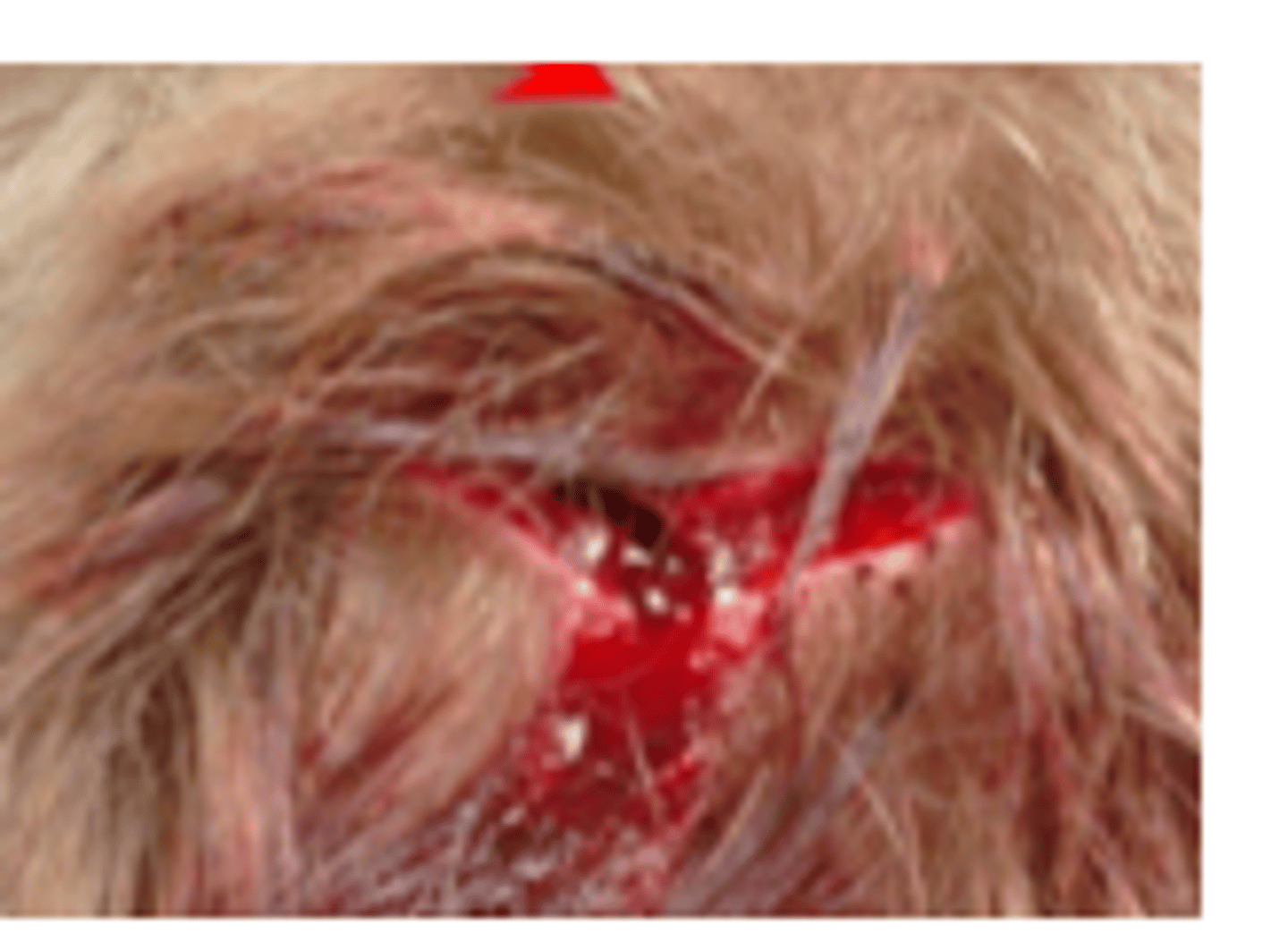 <p>Compression (blunt object striking skin at right angle)</p>